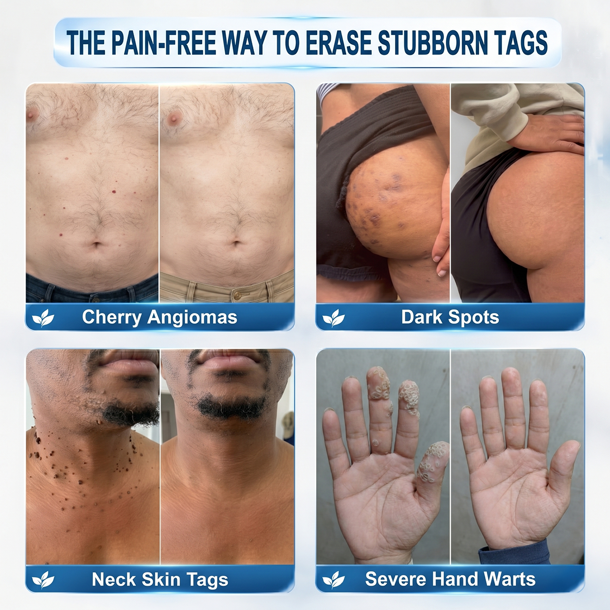 FDA Registered Facility | LUMIVO™ 7-Day Skin Tag & Spot Eraser Painless & Scar-Free Advanced Imperfection Removal Rollerball Pen