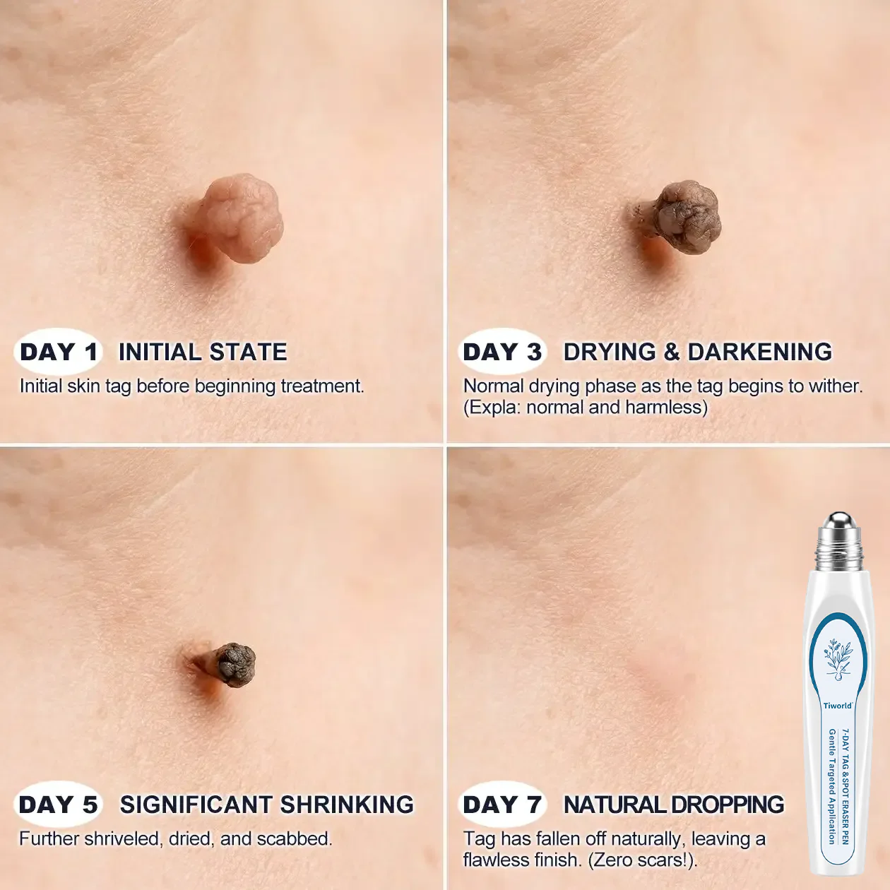 FDA Registered Facility | LUMIVO™ 7-Day Skin Tag & Spot Eraser Painless & Scar-Free Advanced Imperfection Removal Rollerball Pen